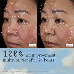 Before and after comparison of redness from using Dieux Instant Angel on a person's face.

Text: 100% had improvement in skin barrier after 24 hours*

*based on an independent clinical study of 40 participants, measured via instrumentation