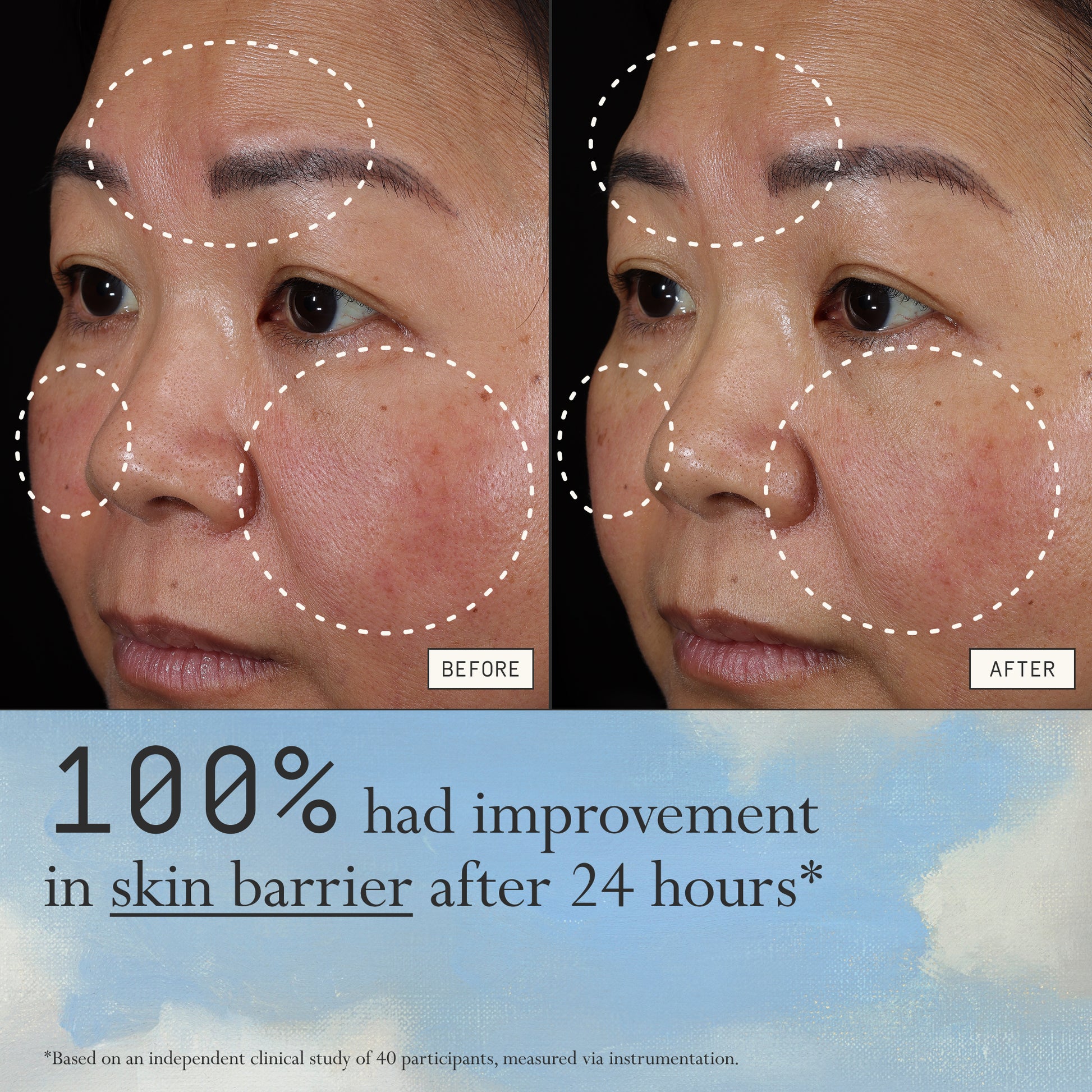 Before and after comparison of redness from using Dieux Instant Angel on a person's face.

Text: 100% had improvement in skin barrier after 24 hours*

*based on an independent clinical study of 40 participants, measured via instrumentation