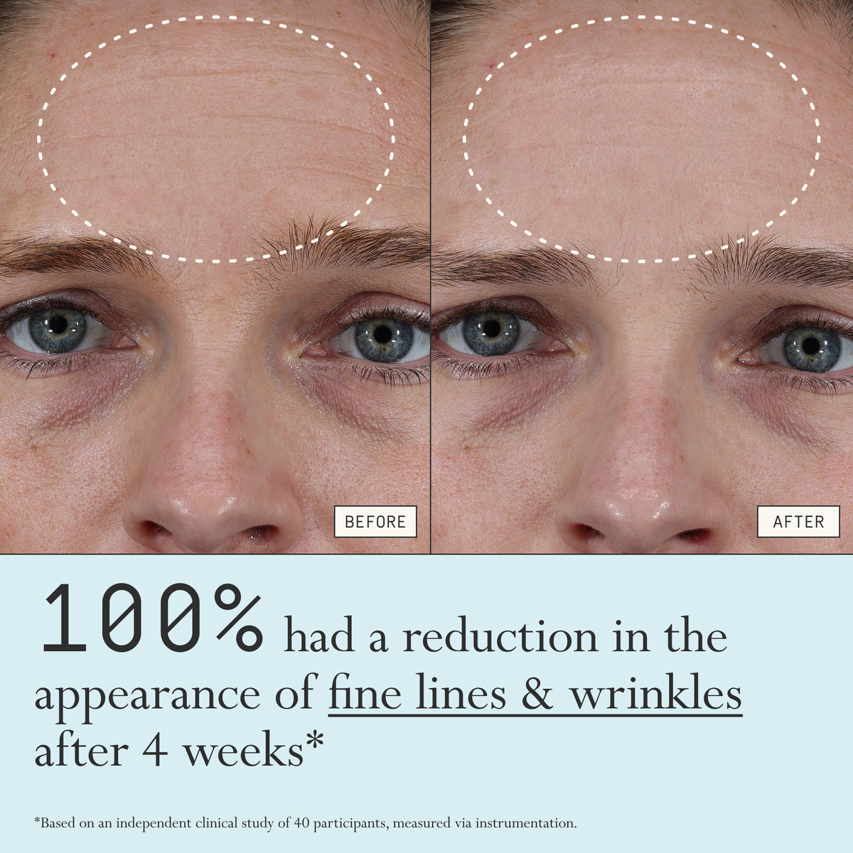 Before and after comparison of fine lines and wrinkles from using Dieux Instant Angel on a person's forehead.

Text: 100% had a reduction in the appearance of fine lines & wrinkles after 4 weeks