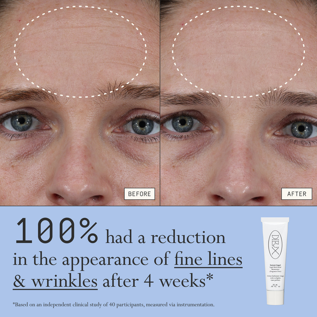 Before and after comparison of fine lines and wrinkles from using Dieux Instant Angel on a person's forehead.

Text: 100% had a reduction in the appearance of fine lines & wrinkles after 4 weeks