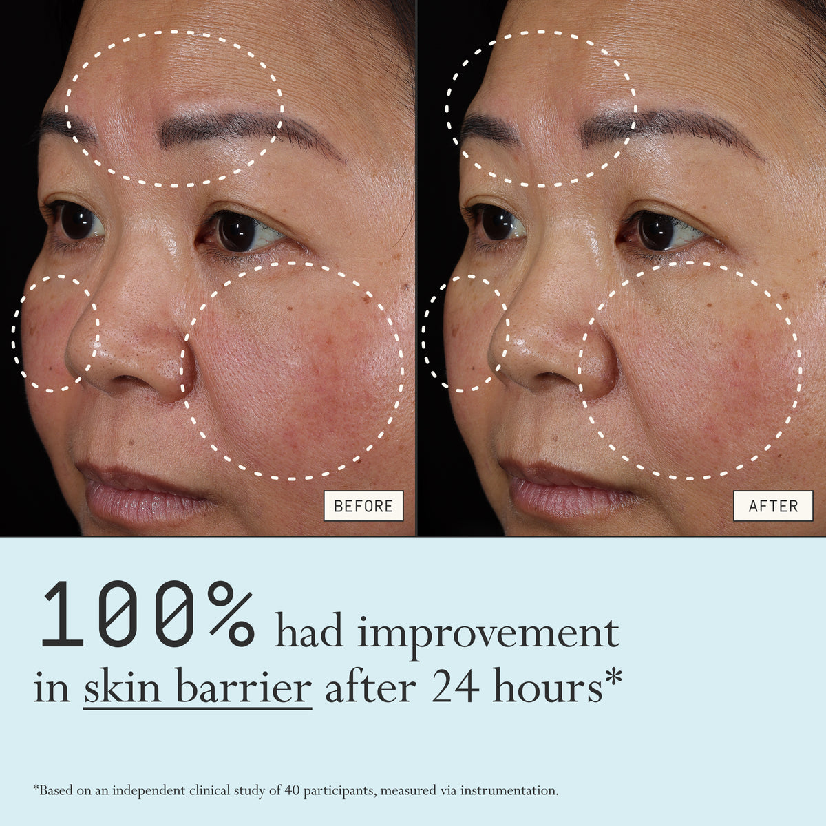 Before and after comparison of redness from using Dieux Instant Angel on a person's face.

Text: 100% had improvement in skin barrier after 24 hours