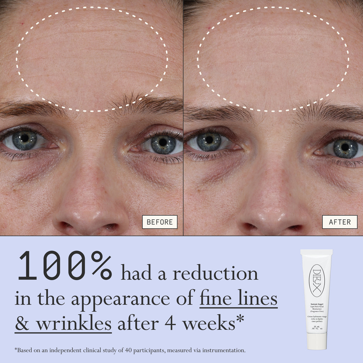 Before and after comparison of fine lines and wrinkles from using Dieux Instant Angel on a person's forehead.

Text: 100% had a reduction in the appearance of fine lines & wrinkles after 4 weeks