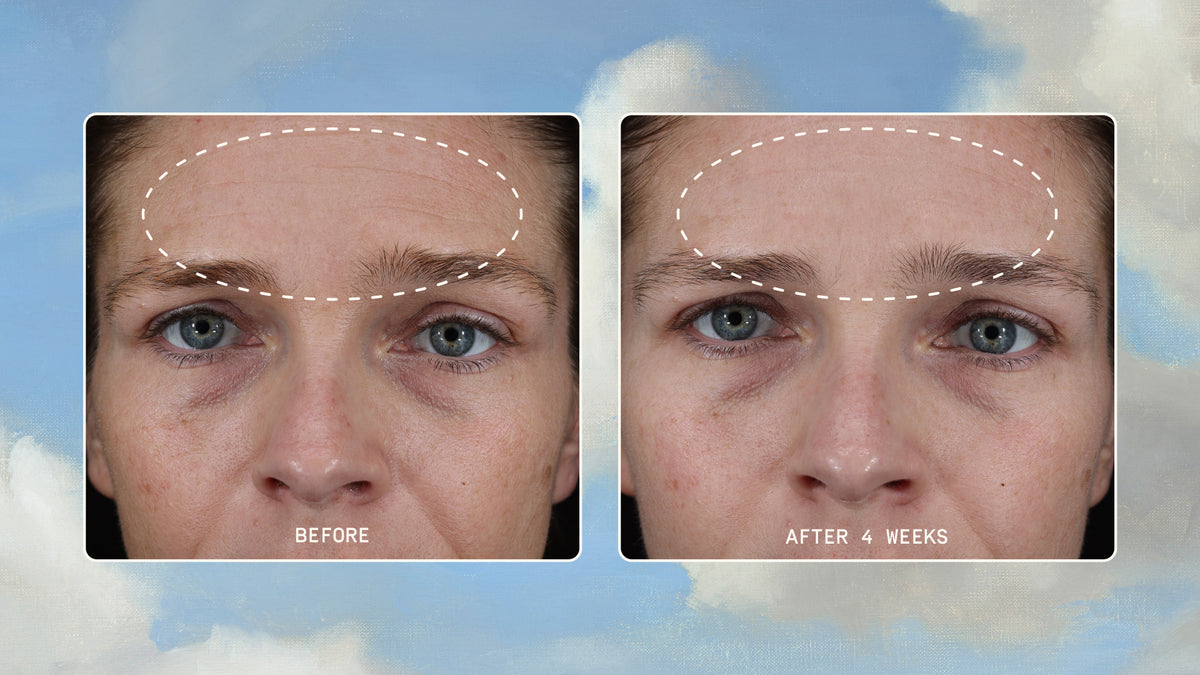 Clinical forehead comparison showing Instant Angel barrier repair results