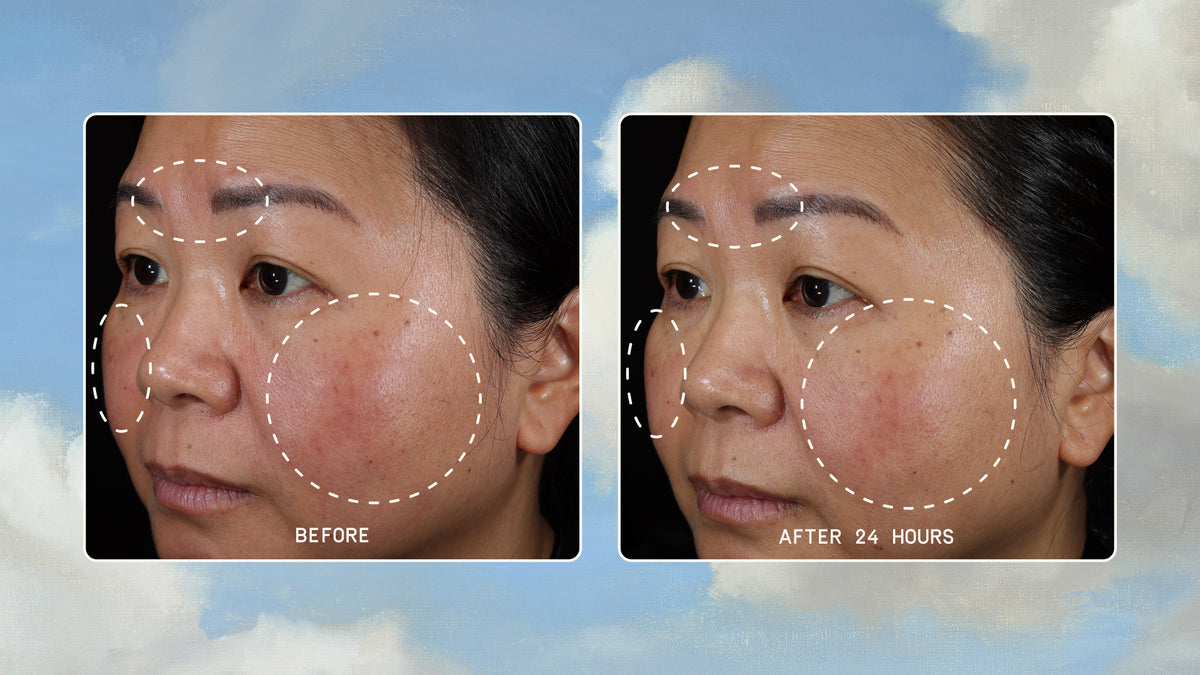 Clinical cheek comparison showing Instant Angel barrier repair results