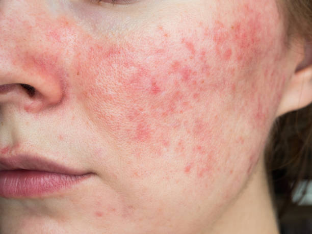 Close-up of irritated red skin on a cheek